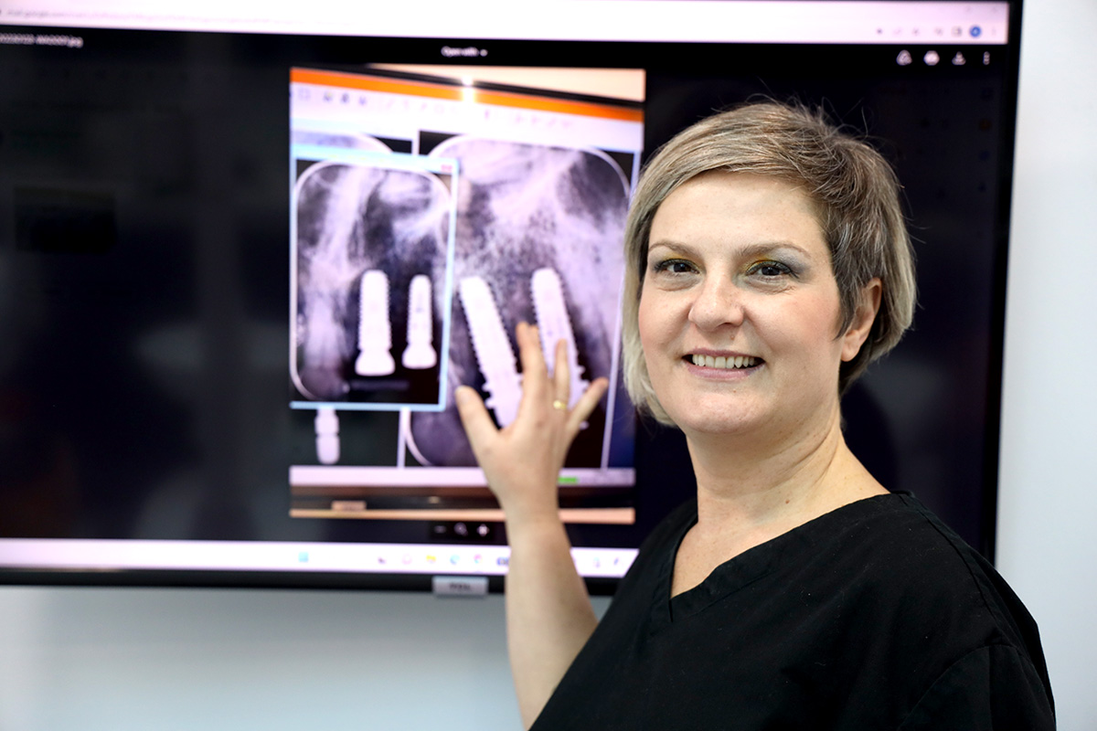Dental implants
