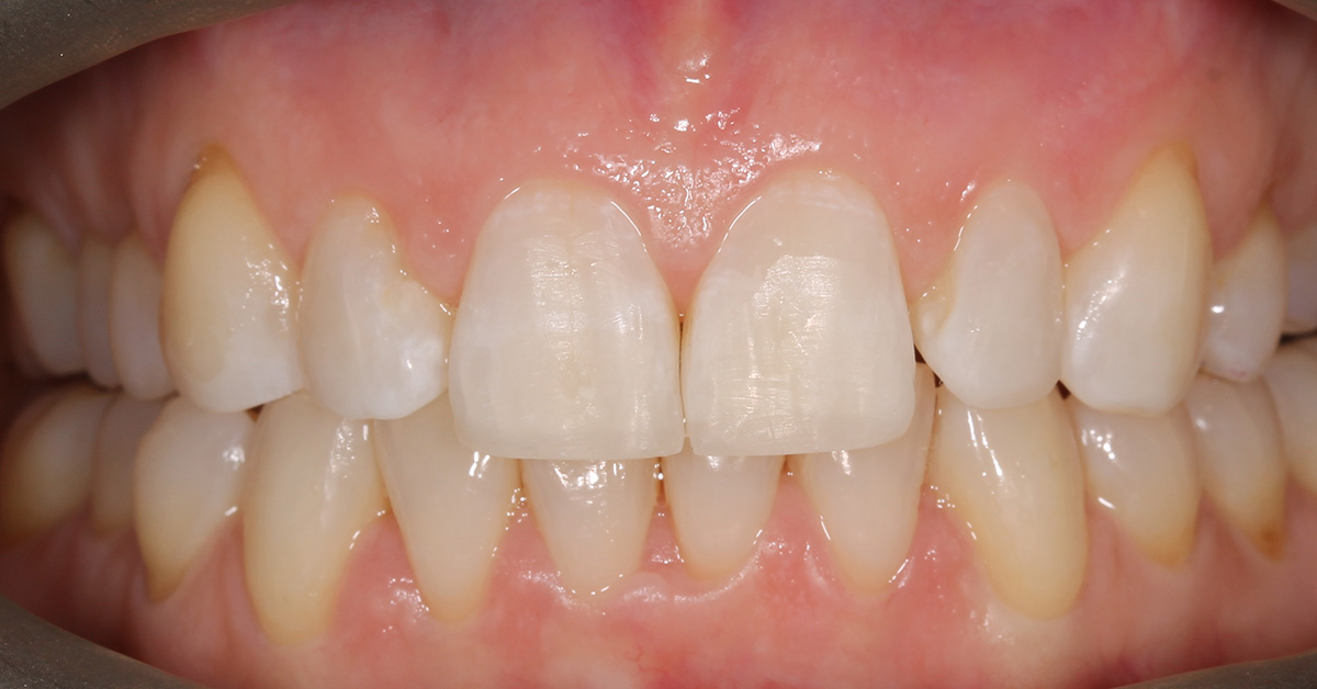 nuvola teeth straightening islington after