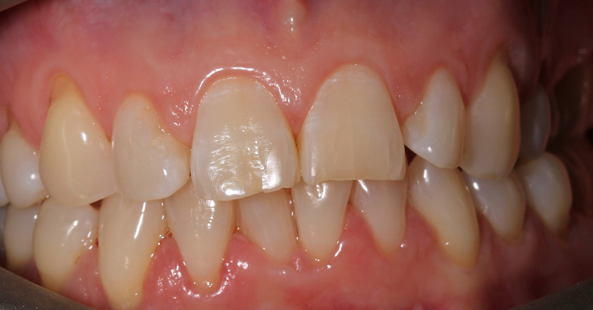 nuvola teeth straightening islington before nuvola teeth straightening islington before