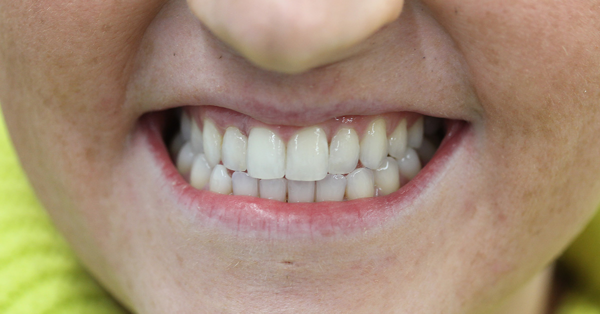 patient k after treatment islington dentist