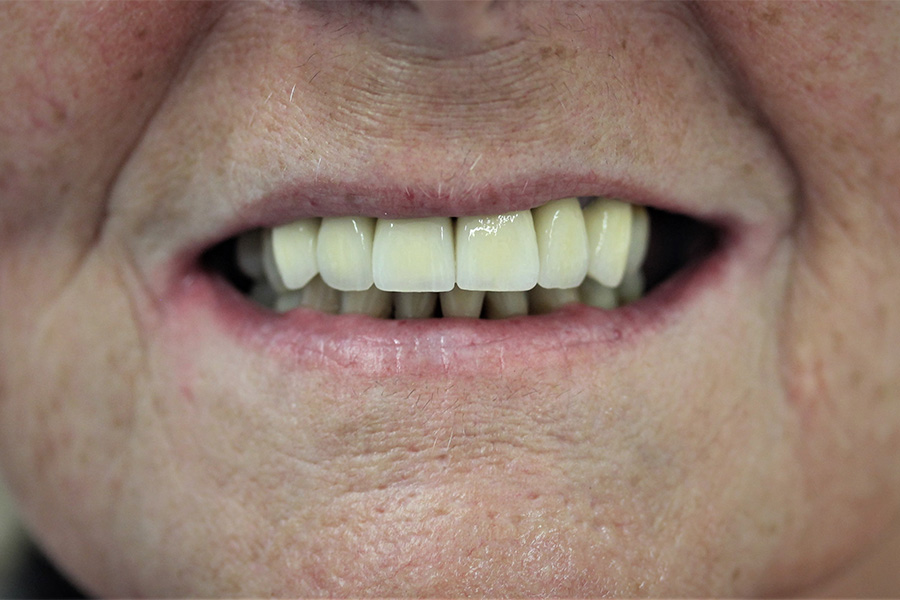 dental implants after