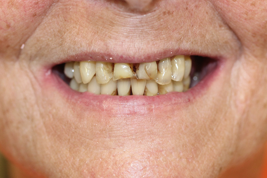 Dental Implants Before