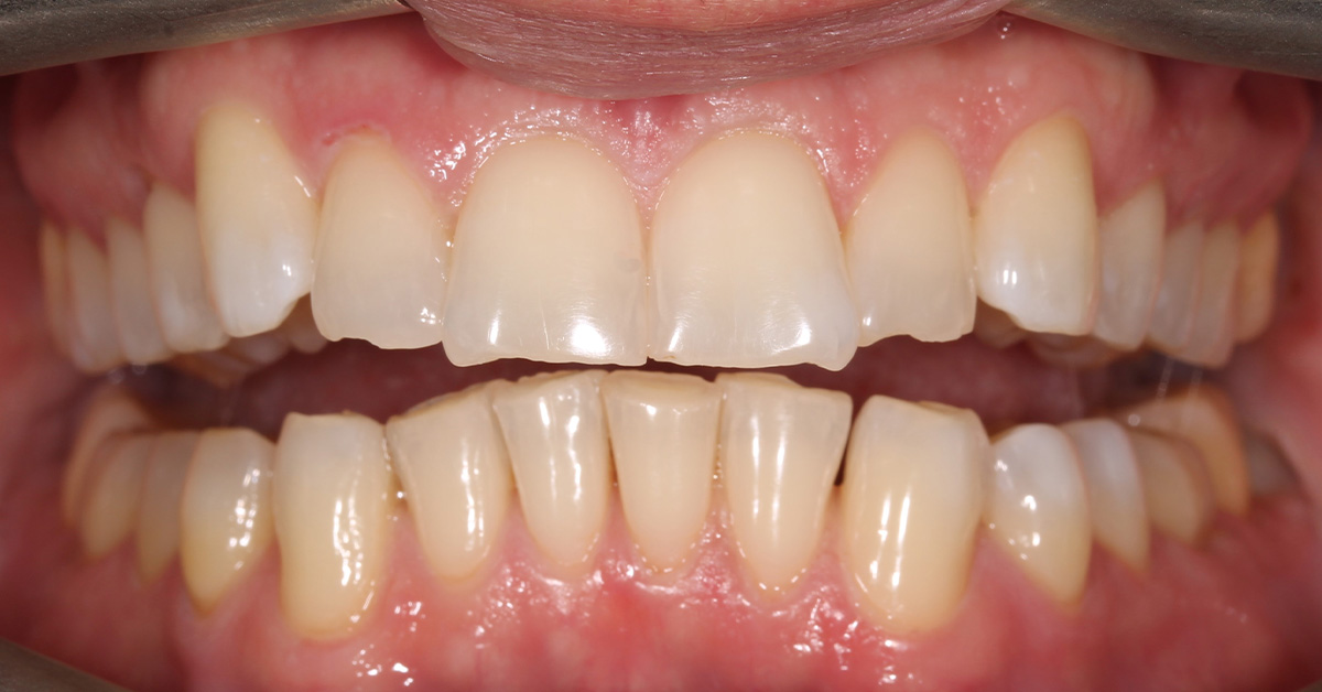 after teeth whitening