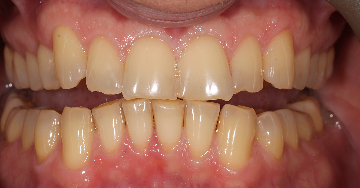 before teeth whitening