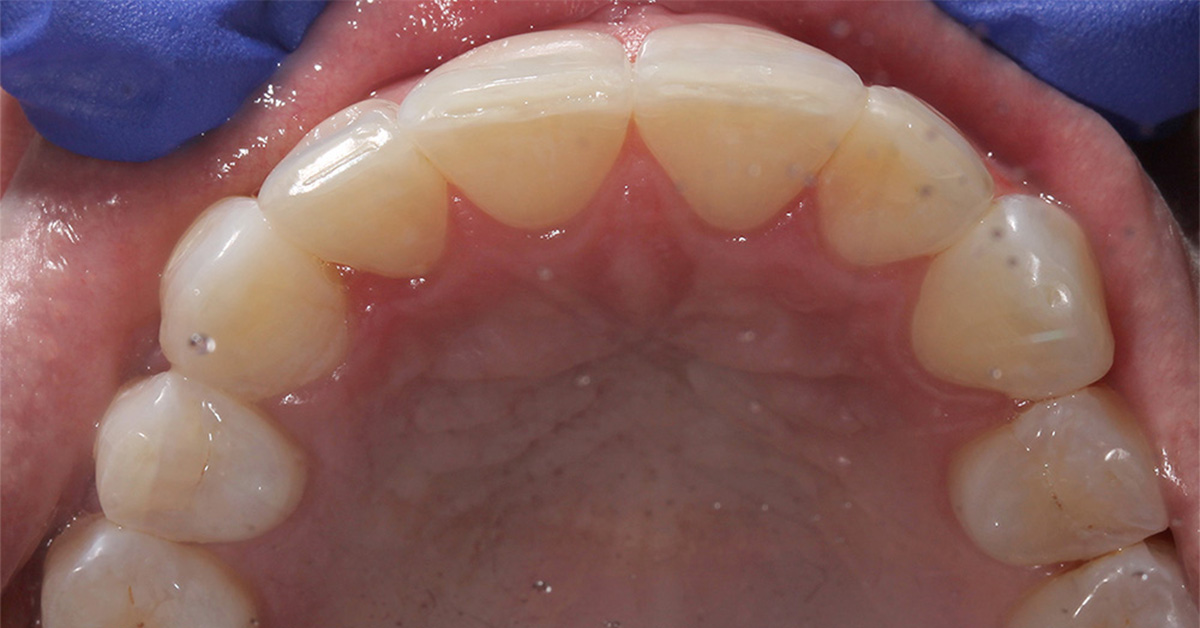 teeth straightening after