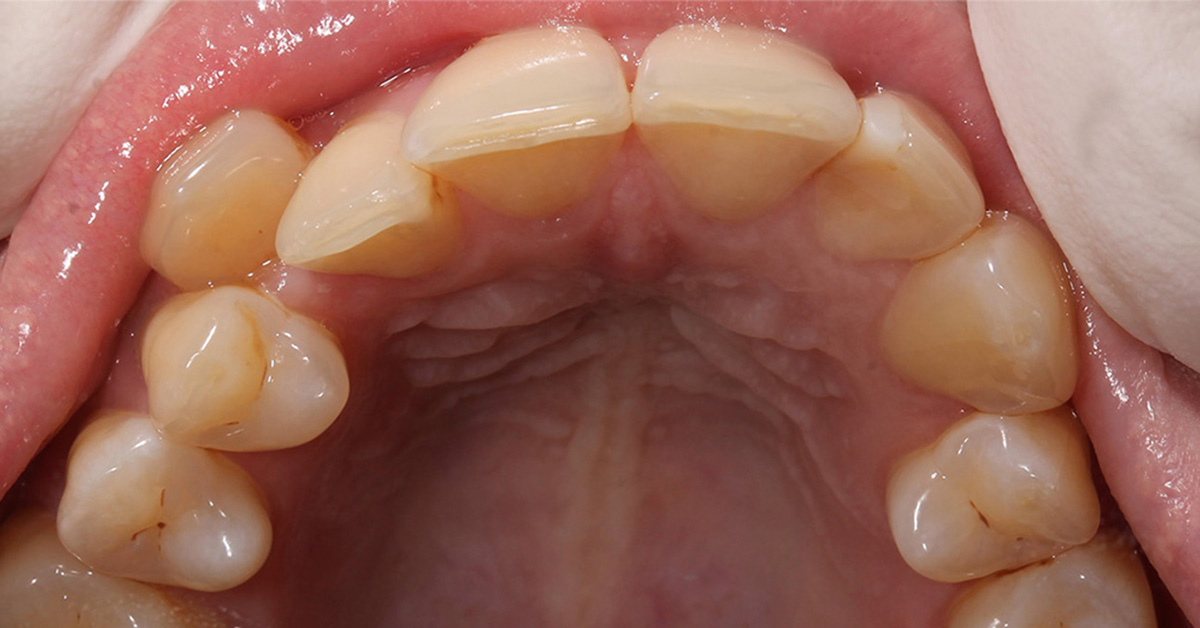 teeth straightening before teeth straightening before