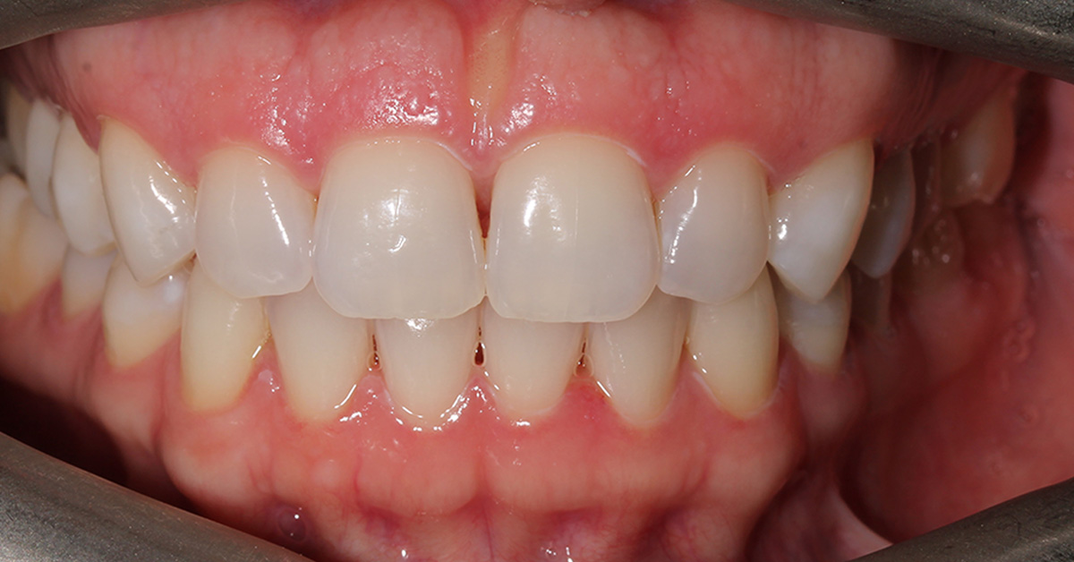 after teeth whitening islington dentist 1
