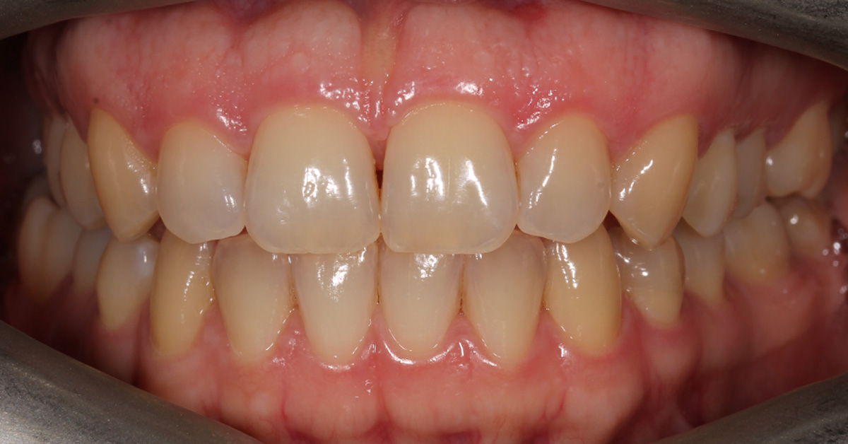 before teeth whitening islington dentist 1